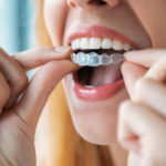Understanding Braces Retention Protocols and Long-Term Smile Stability