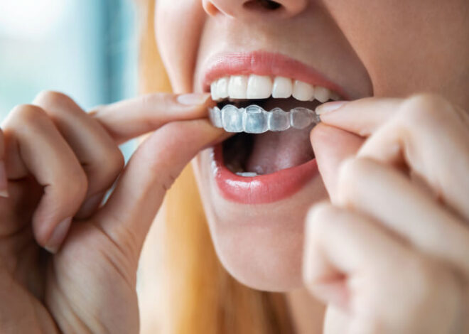 Understanding Braces Retention Protocols and Long-Term Smile Stability