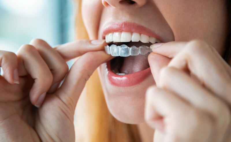 Understanding Braces Retention Protocols and Long-Term Smile Stability