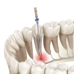 How Endodontists Use Advanced Microscopy to Save Teeth That General Dentists Cannot Treat